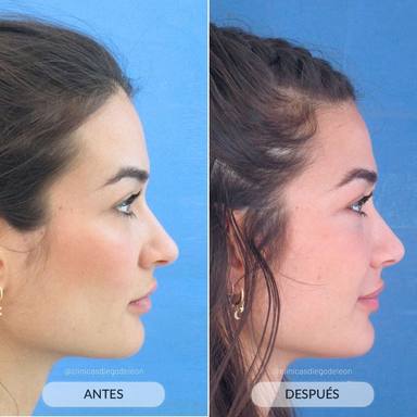 El antes y el después de la nariz de Estela Grande tras pasar por quirófano