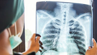 Cáncer de pulmón síntomas y diagnóstico
