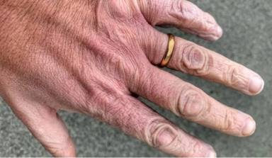 Las reveladoras imágenes de las manos de un sanitario italiano que lucha contra la COVID: Un ardor intenso