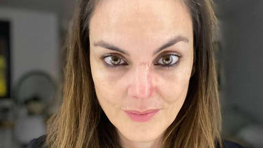 Mónica Carrillo anuncia que padece cáncer de piel con unas impactantes imágenes