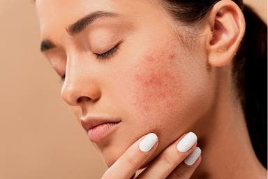 Com evitar l'acne i les irritacions que provoquen les mascaretes