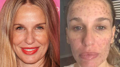 El antes y el después de la actriz Carola Baleztena y su denuncia tras un tratamiento estético