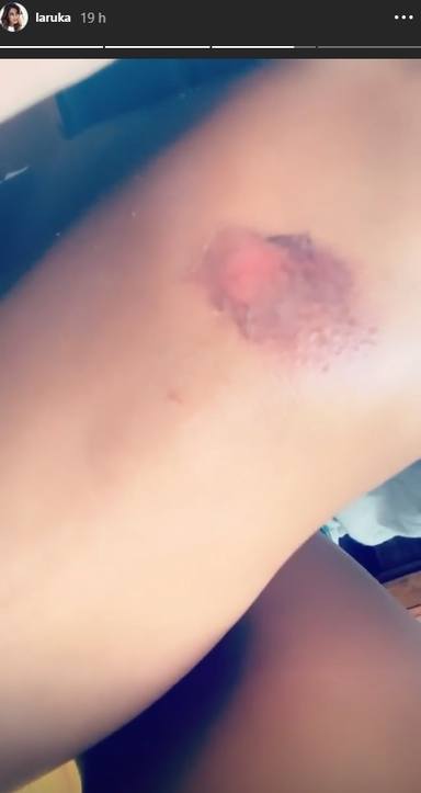 Heridas de Lara Álvarez