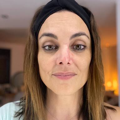 La cicatriz de Mónica Carrillo tras luchar contra un cáncer de piel en la nariz